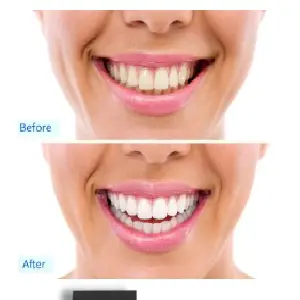 Dental White Mini Luz Blanqueadora para