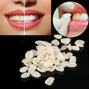 Carillas Dentales: Pack x 50 Unidades - Carillas Dentales Pack x 50