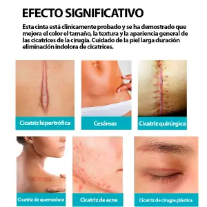 Rollo cinta silicona para cicatrices