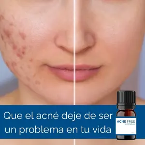 ACNE FREE - Elimina el Acné