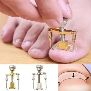 Uñas Encarnadas ?Corrector solución ⚡