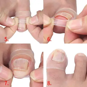 Corrector Uñas Encarnadas Uñero Pie 1par