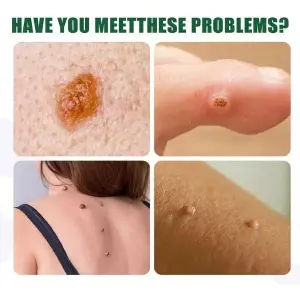 QUITA VERRUGAS PARCHES