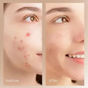 Limpiador Facial Ultrasónico Peeling Ant