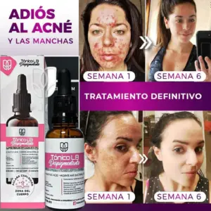 TRATAMIENTO PARA EL ACNE