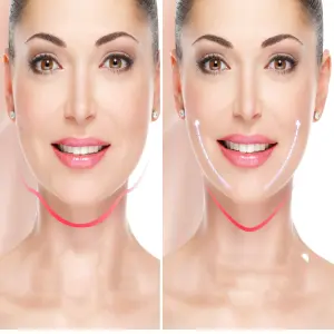 ESTIRAMIENTO FACIAL EN V