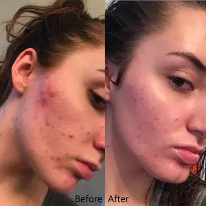 Differin Gel de Adapaleno: Tu Solución Clara para la Piel - Differin Gel De Adapaleno