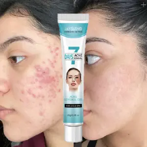 Crema Tratamiento Acné Mascarilla Facial: Tu Piel Radiante y Sana - Crema tratamiento acne mascarilla facial
