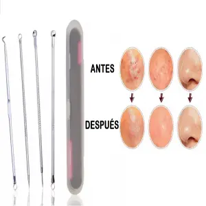 Extractor de Espinillas y Puntos Negros: Piel Perfecta al Alcance de Tu Mano - 430019-EXTRACTOR DE ESPINILLAS  Y PUNTOS